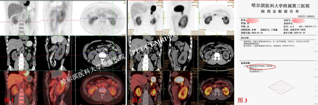 肾癌检查报告图片